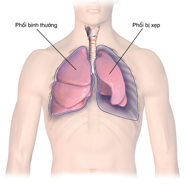 Các triệu chứng và biến chứng tràn khí màng phổi ta cần biết